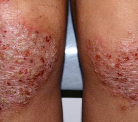 遗传过敏性皮炎