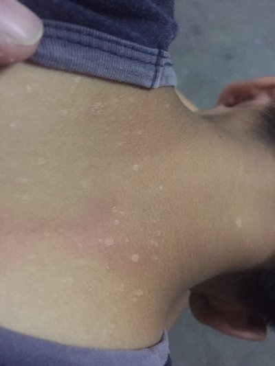 上身起湿疹是什么原因?