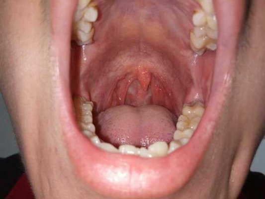 裂纹舌有哪些症状?