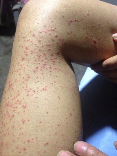 慢性红斑狼疮症状