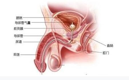 前列腺有结石什么症状?