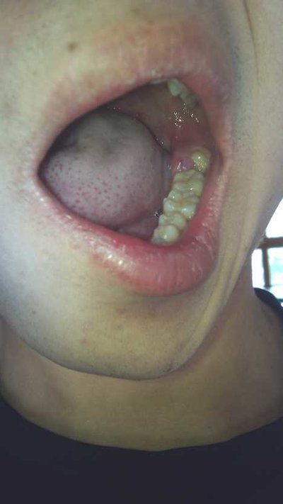 牙龈炎的症状图片图片
