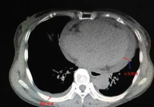 心包积液症状图片