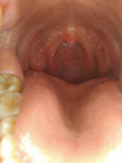 喉癌的早期症状和前兆图片
