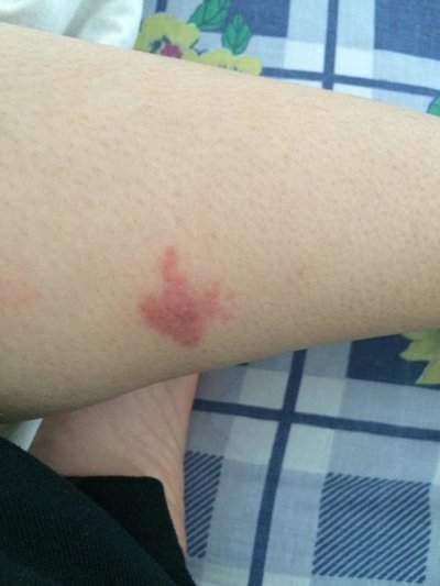 慢性的过敏性紫癜的症状