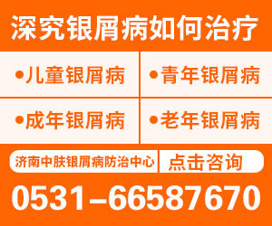 济南治疗牛皮癣医院