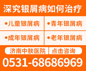 济南治疗牛皮癣医院
