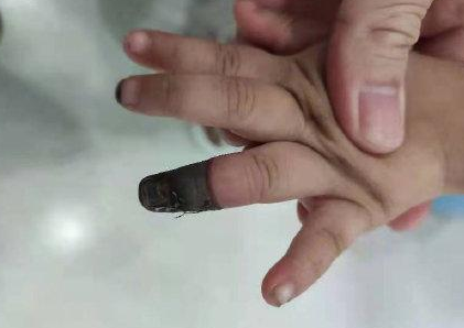 错误包扎致3岁女童手指坏死：创可贴三大使用误区，请您坚决避免