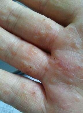 汗疱疹的典型症状有哪些,如何与手足癣辨别