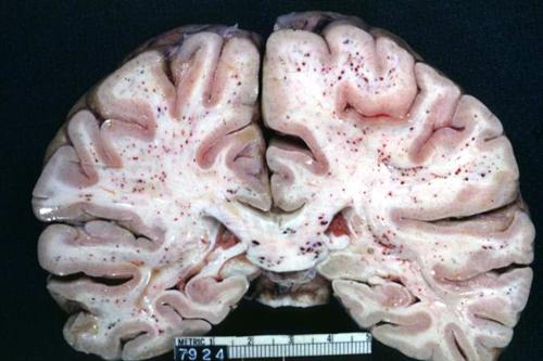 脑组织肿胀图片