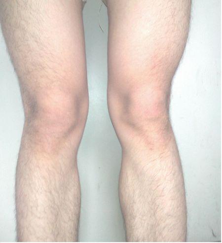 x型腿 男生图片