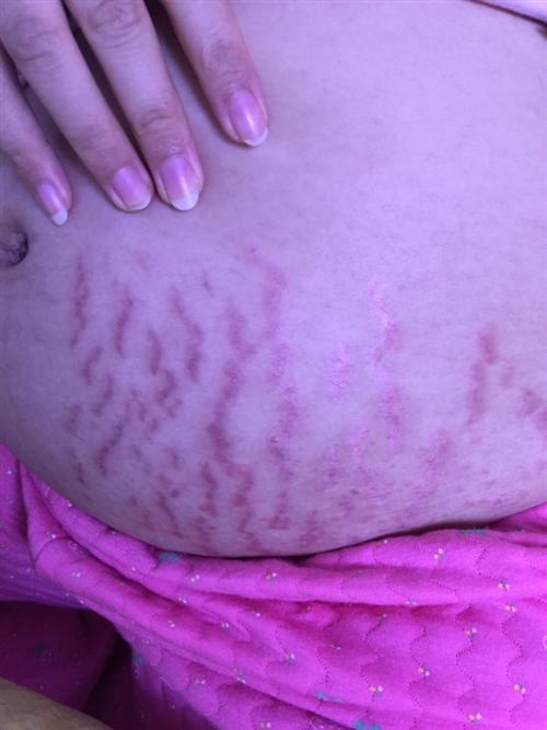孕七个月长妊娠纹图片图片