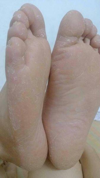 坐月子脚干的脱皮怎么弄百科在线
