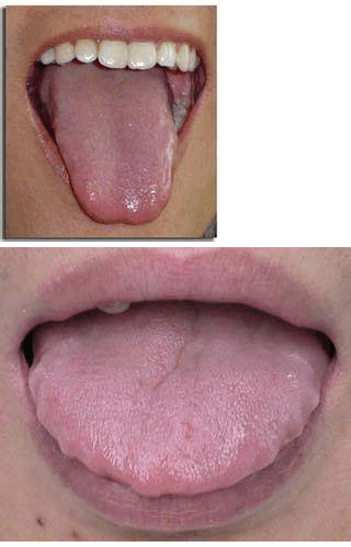 严重齿痕舌图片图片