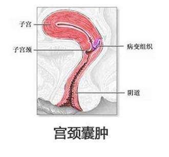 宫颈多发性囊肿图片