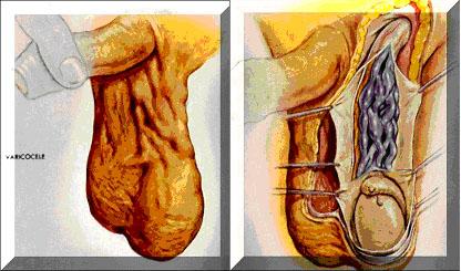 精索静脉曲张的照片图片