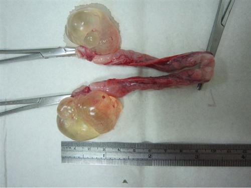 15cm卵巢囊肿图片图片