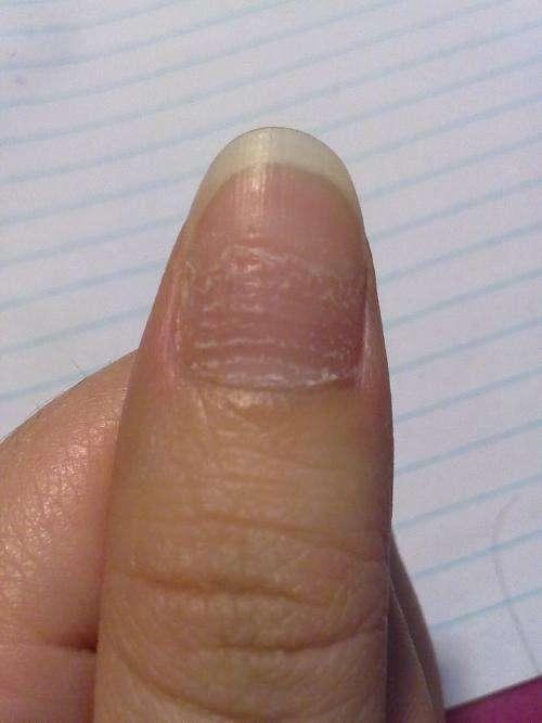 手指甲凹凸不平的原因是什么？