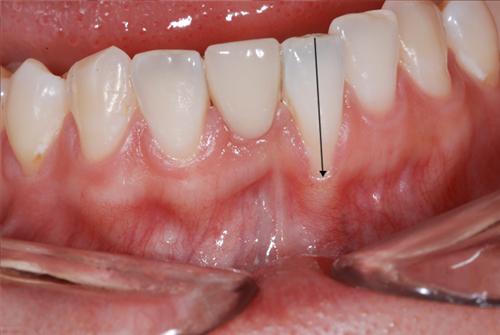 牙龈萎缩早期症状图片