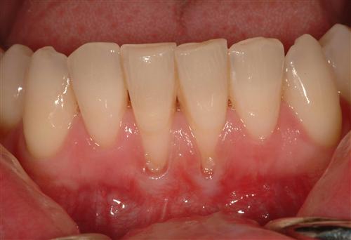早期牙龈萎缩图片图片