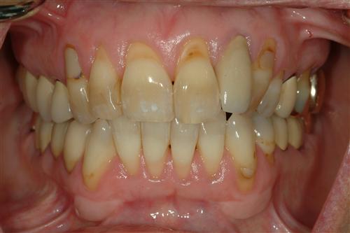 牙牙龈萎缩是怎么回事
