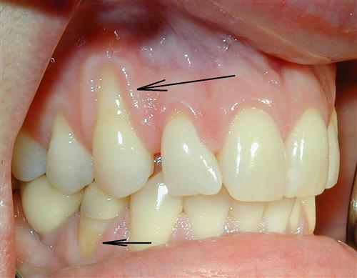 牙龈萎缩各个阶段图片图片