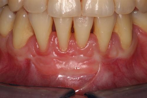 牙龈萎缩各个阶段图片图片