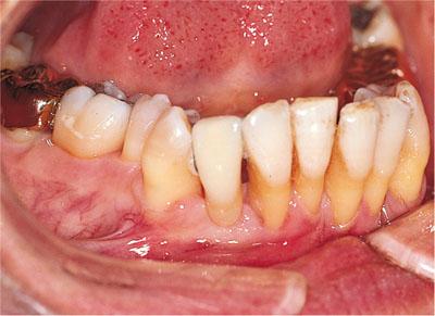 牙龈萎缩早期症状图片