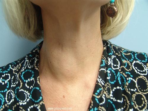 甲状腺峡部结节图片图片
