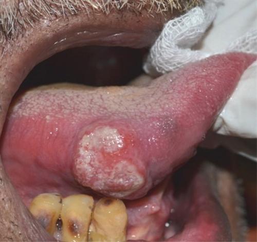 舌头溃疡 侧面图片