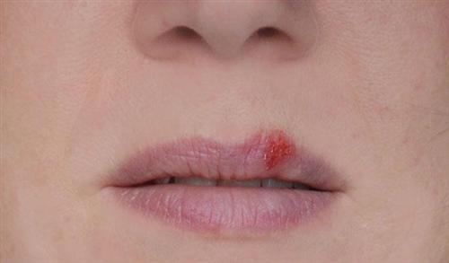 口唇疱疹初期怎么治疗