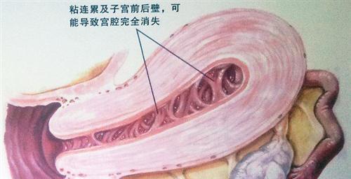 宫腔线分离图片