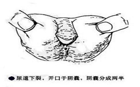 尿道下裂类型图解图片