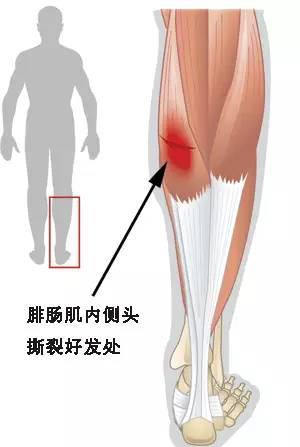 肌肉拉伤是怎么回事图片