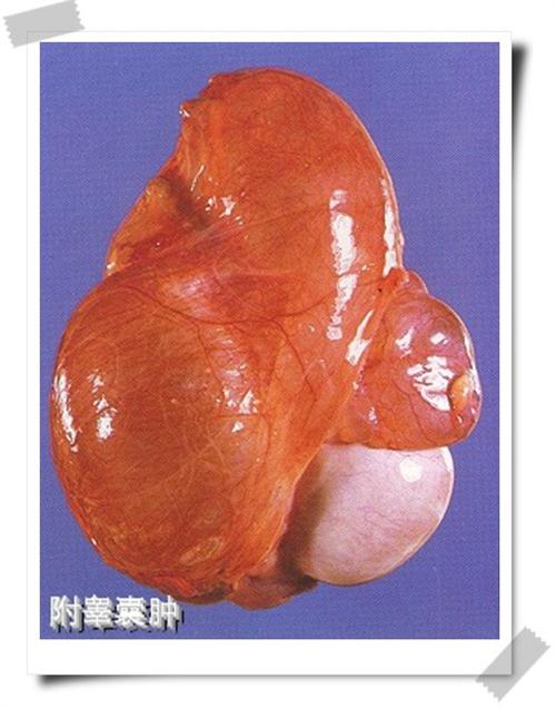 附睾肿瘤图片