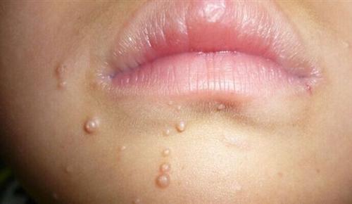 儿童口唇疱疹症状图片图片