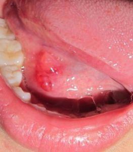 口腔上颚黏膜溃疡图片图片