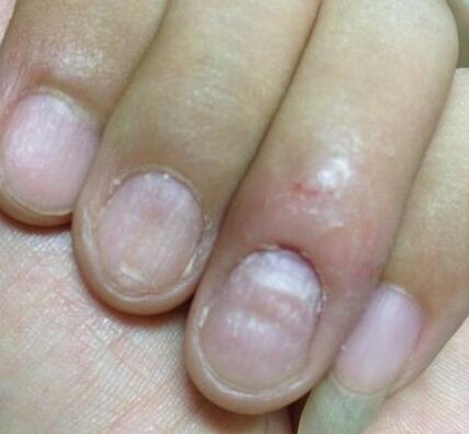 指甲异常