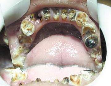 发病部位:并发疾病热门问答牙釉质腐蚀后有异味怎么办牙齿牙釉质腐蚀