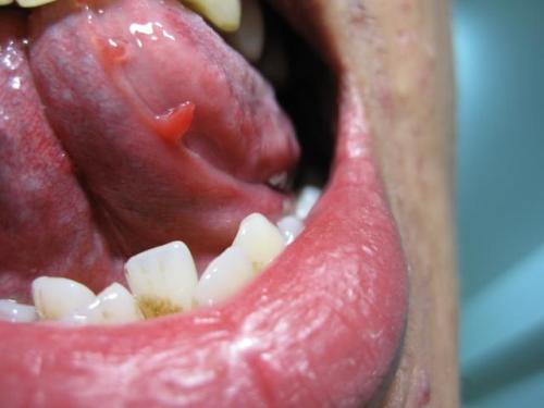 舌乳头炎 患者图片