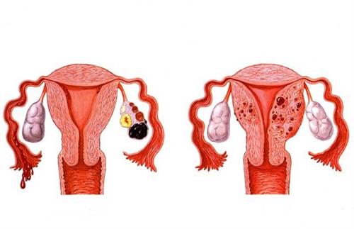 绝经后子宫内膜增厚怎么办?