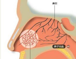鼻粘膜出血