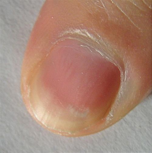 哪种指甲是癌症 白斑图片