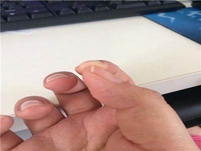 大拇指指甲分层图片图片