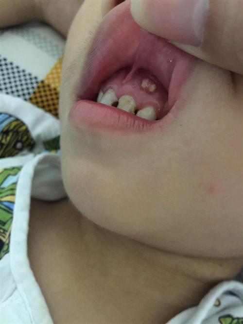 牙根疮的症状图片图片