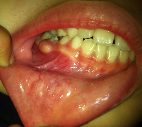 牙龈溃疡的症状图片图片