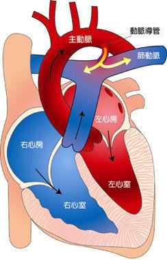 新生儿动脉导管未闭图片