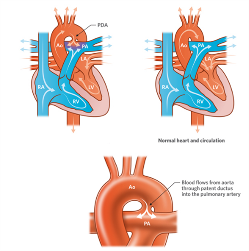 新生儿动脉导管未闭图片