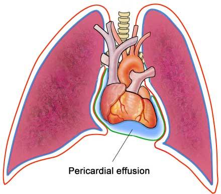 pericardial cavity图片