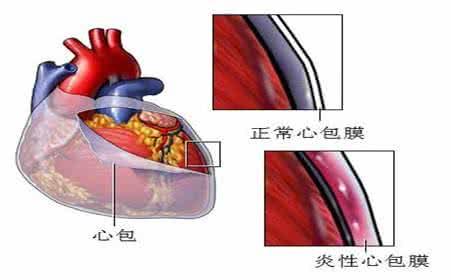 心包积液体征图片